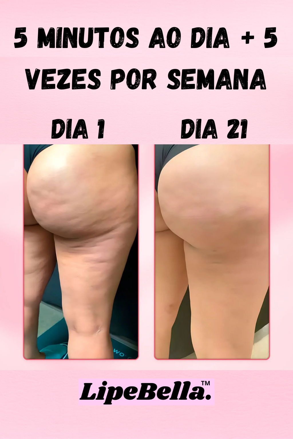 Kit LipeBella™ – Alívio Lipedema